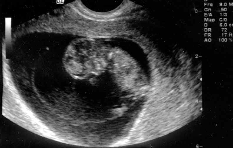 سونوگرافی هفته ده بارداری